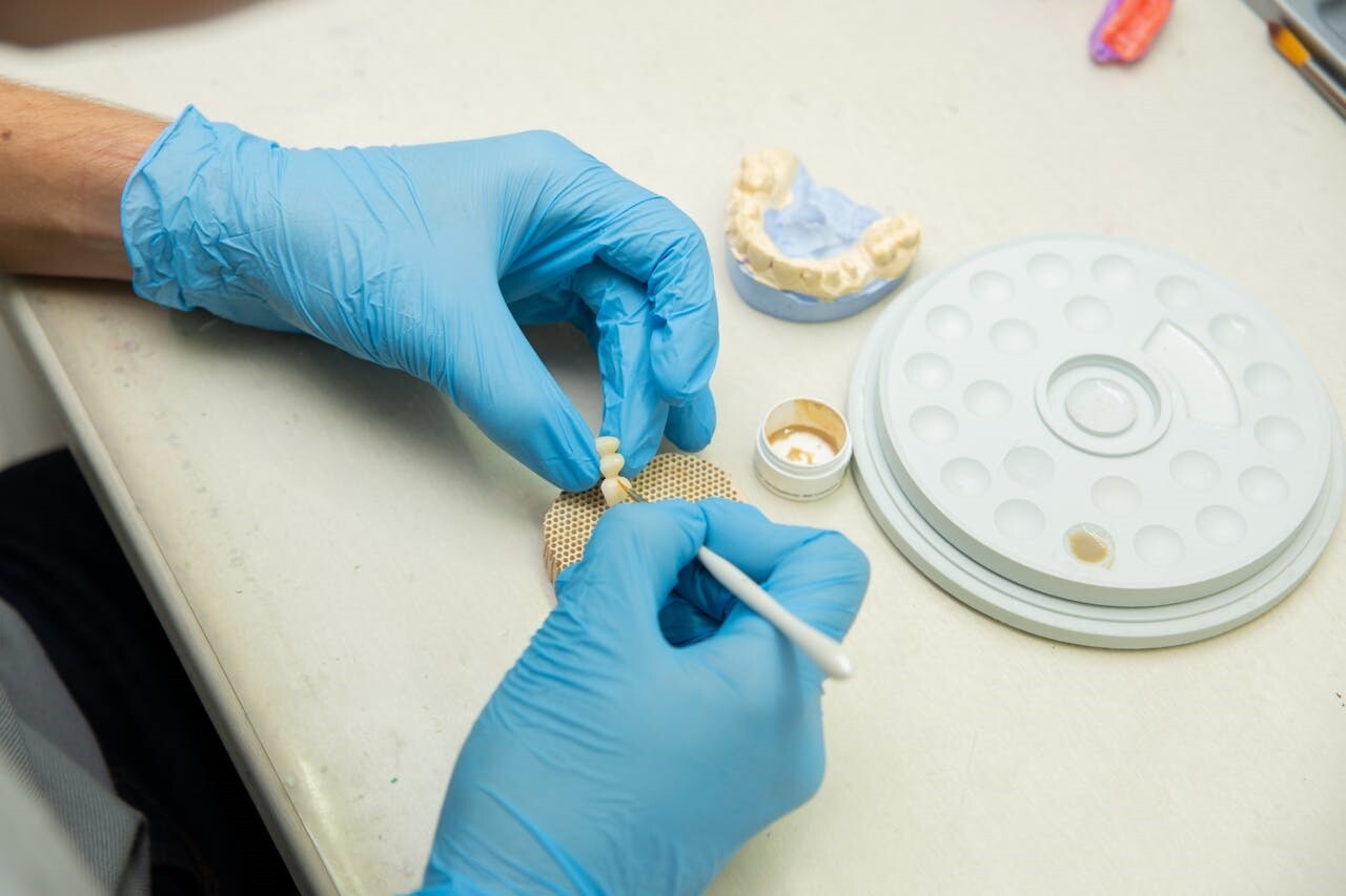 The Long-Term Advantages of Fixed Implant Bridges