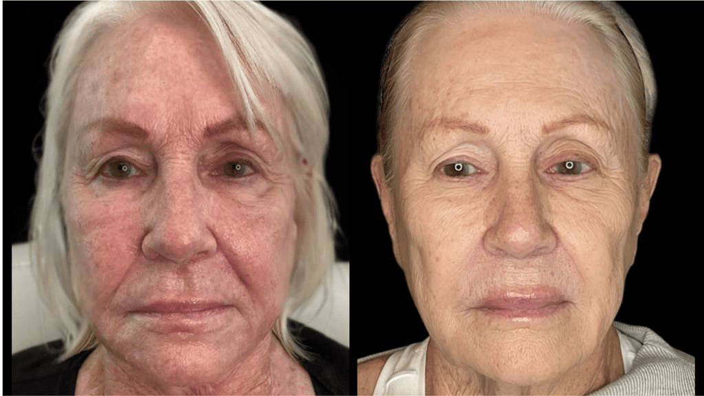 microneedling before and after